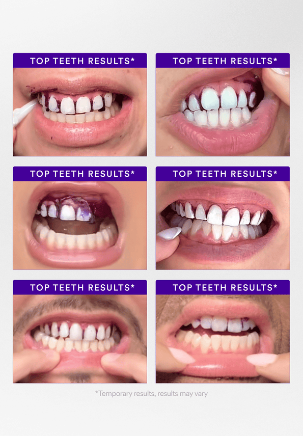 Whitening Strips